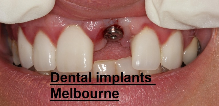 Dental Implants