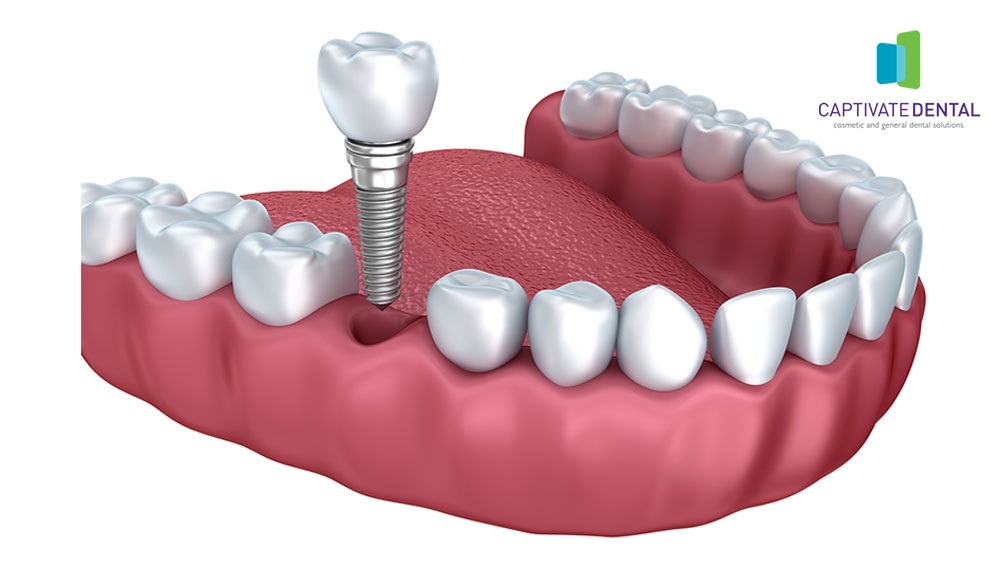 dental implant in Melbourne