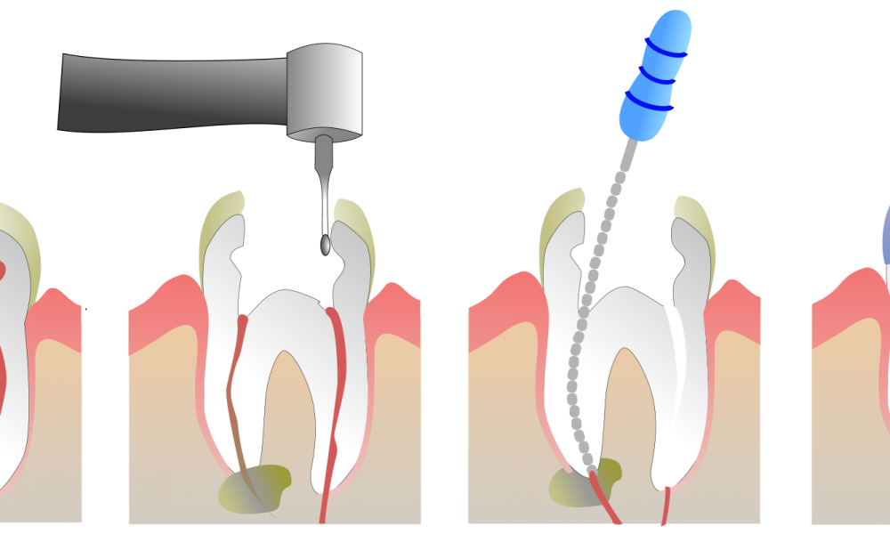 Root Canal Treatment