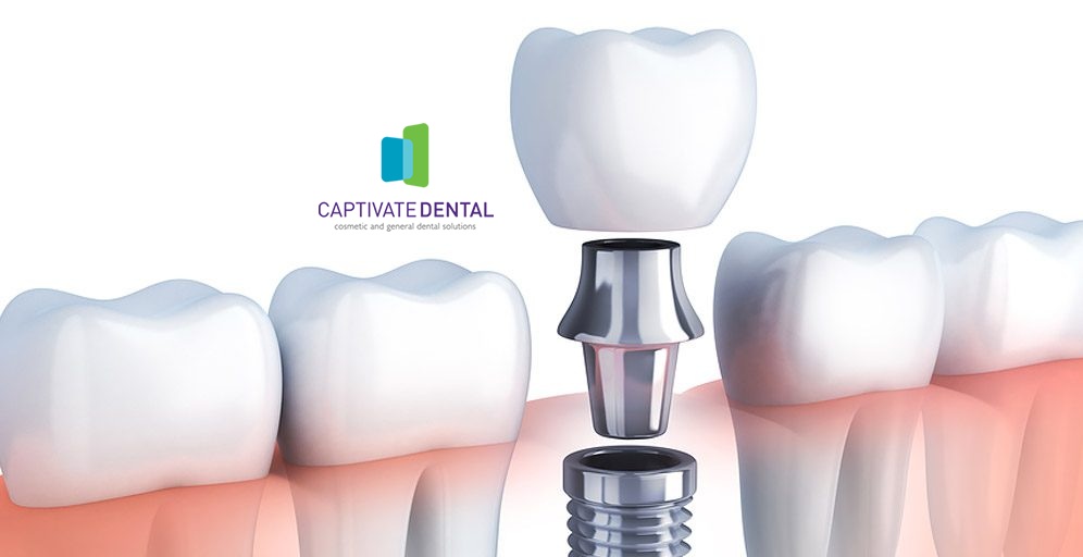 dental implants in Melbourne