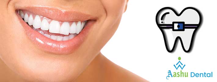 Clear Braces Services in Ahmedabad