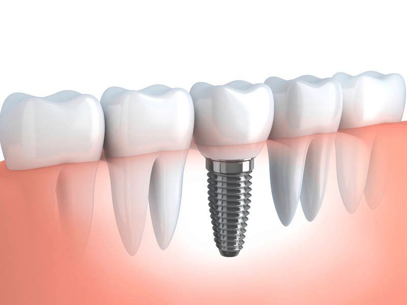 What are the Warning Signs of Dental Implants Failure?