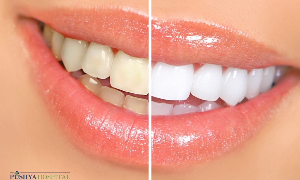 tooth whitening in ahmedabad