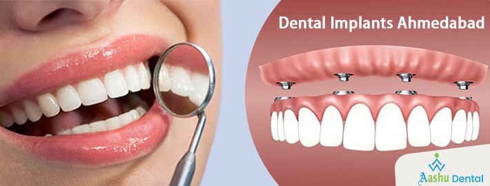 reason to look into Dental Implant Treatment